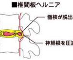 泉大津 松之浜整骨院 ヘルニア