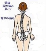 ゆがみ型肩こり