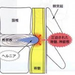 ヘルニアの説明